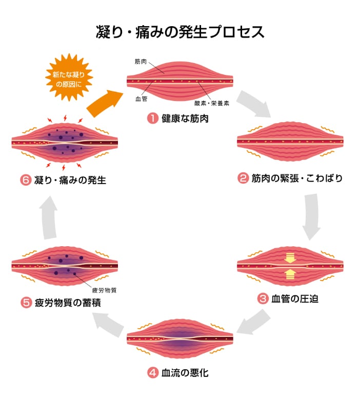 凝り・痛みの発生プロセス